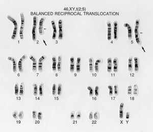 view Balanced reciprocal translocation 46,XY,t(2;5). This male has a chromosomal disorder. A chromosome 2 and a chromosome 5 have exchanged segments. The cell still contains a complete complement of