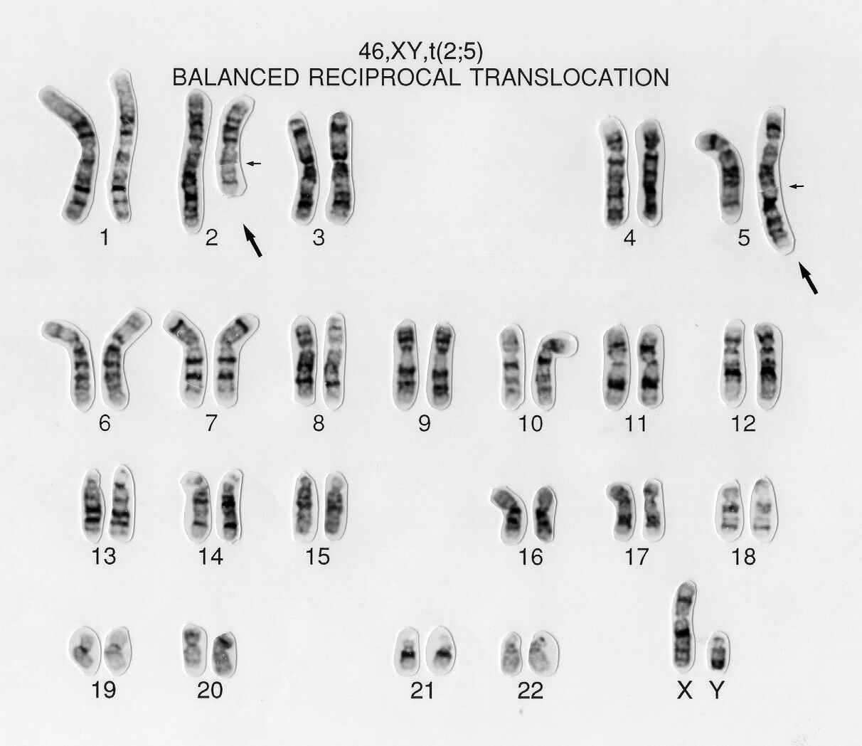 Balanced Reciprocal Translocation 46 Xy T 2 5 This Male Has A Chromosomal Disorder A Chromosome 2 And A Chromosome 5 Have Exchanged Segments The Cell Still Contains A Complete Complement Of Wellcome Collection