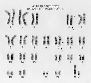 view Balanced translocation 46,XY,t(4;10)