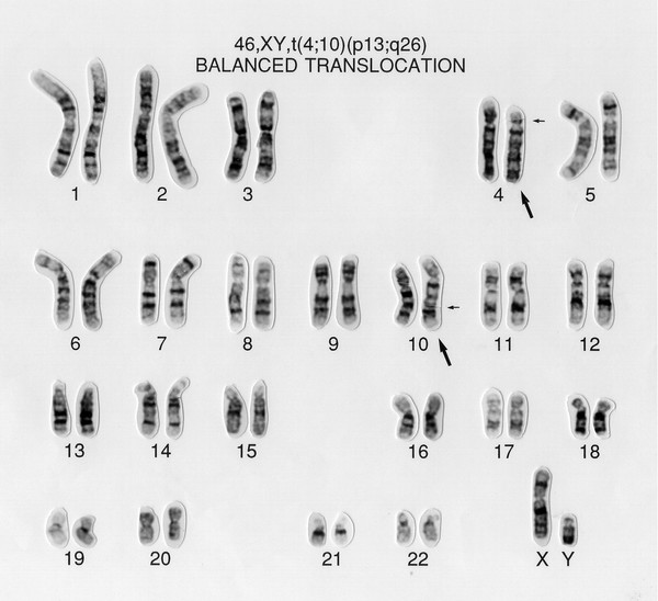 Balanced translocation 46,XY,t(4;10)