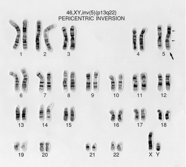 Pericentric chromosome inversion