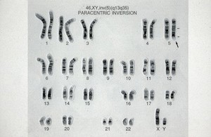 view Paracentric chromosome inversion