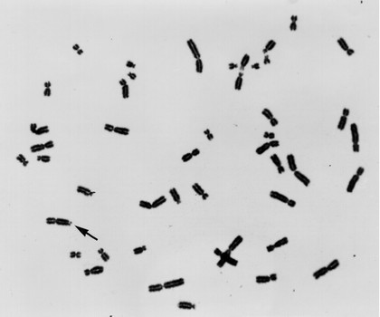 Fragile X metaphase spread