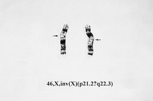 view Inversion in X chromosome