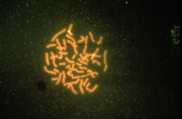 Duchenne muscular dystrophy - normal female, chromosomes have been highlighted by a fluorescent probe for exon 45/47 (note the double yellow band). This disorder is caused by a recessive gene on the X chromosome, so is normally shown only by males, who lack a second X chromosome. The condition starts with difficulty in walking and climbing stairs in early childhood, usually resulting in confinement to a wheelchair by the age of 10, with death from respiratory infection or cardiac failure by about the age of 20.