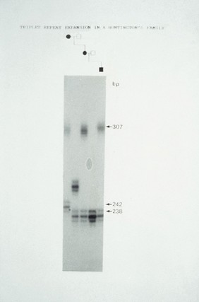 Huntington's chorea pedigree, constructed from