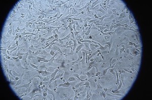 view Abnormal foetal cells in amniotic fluid