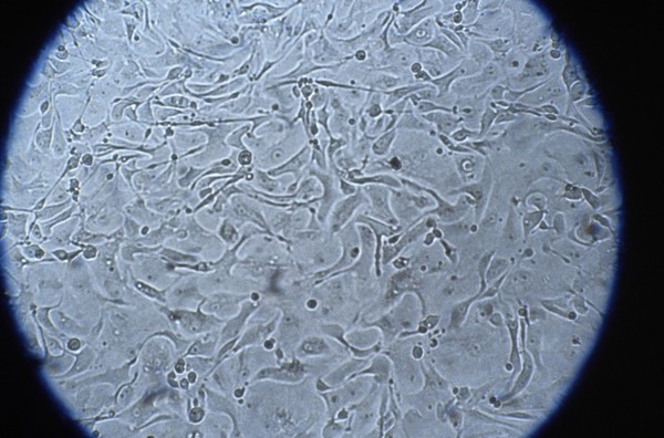 Abnormal foetal cells in amniotic fluid