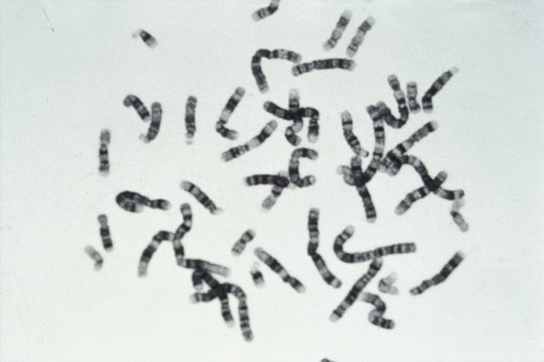 Metaphase, deletion on chromosome 15