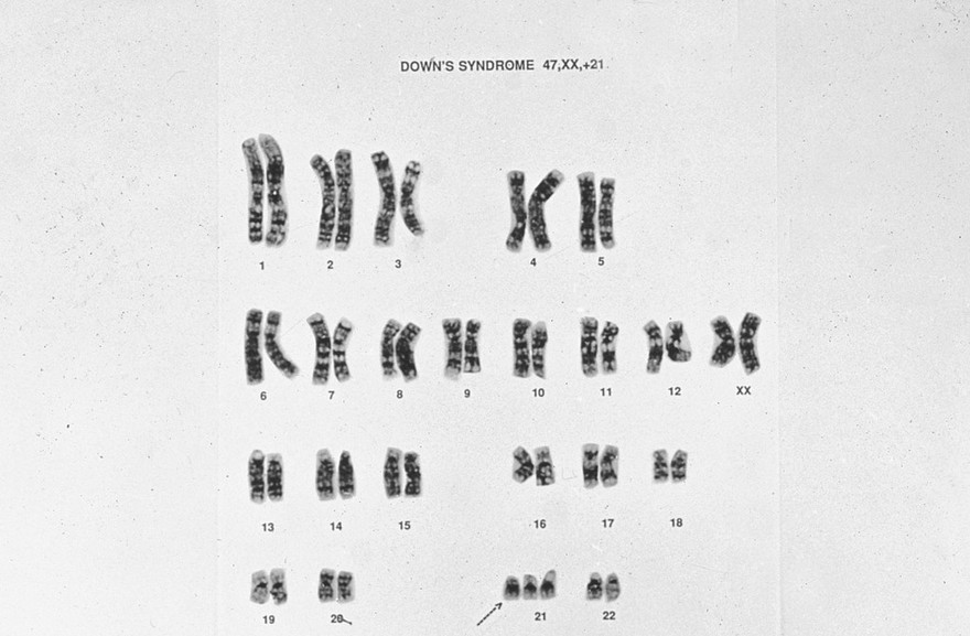 Down's syndrome karyotype 47,XX,+21