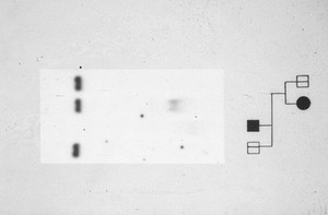 view Fragile X pedigree + rflp autoradiograph