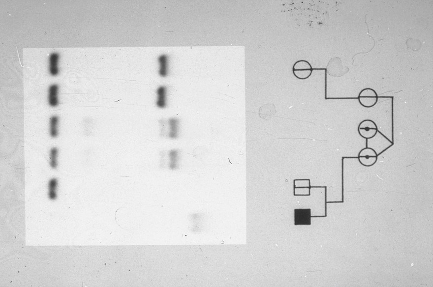 Fragile X pedigree + rflp autoradiograph