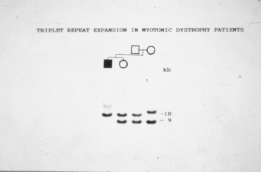Myotonic dystrophy pedigree + rflp autoradio