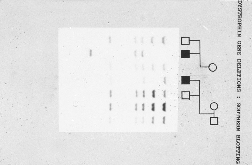 Duchenne muscular dystrophy pedigree + rflp