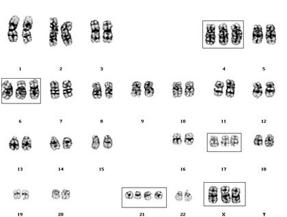 Hyperdiploid acute lymphoblastic leukaemia