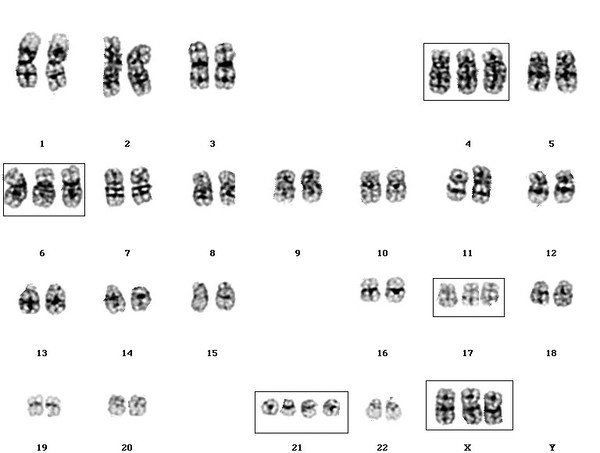 Hyperdiploid acute lymphoblastic leukaemia