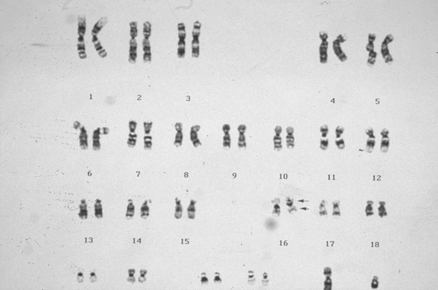 Acute myelomonocytic leukaemia +eosinophilia