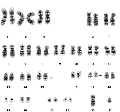 Acute promyelocytic leukaemia karyotype