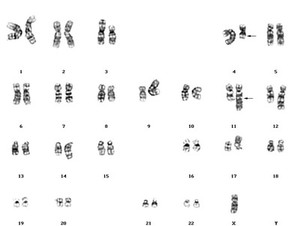 view Leukaemia karyotype t(4;11) etc