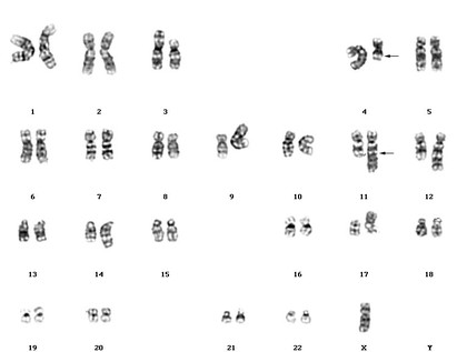 Leukaemia karyotype t(4;11) etc