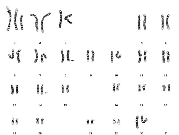 Leukamia karyotype t(8;14)