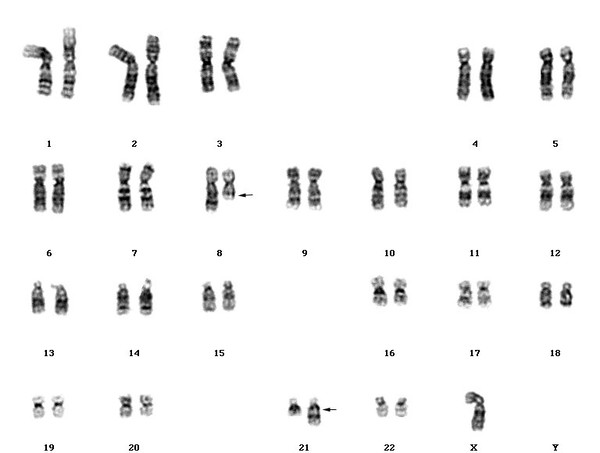 Acute myeloblastic leukaemia karyotype