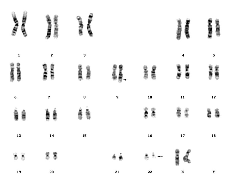 Chronic myeloid leukaemia karyotype 9;22 | Wellcome Collection