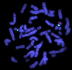 view Familial aniridia deletion shown by cosmid