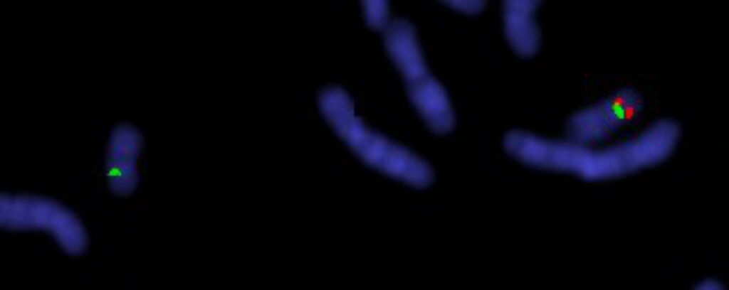Pressure palsy, deletion c'some 17, cosmid