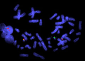 view Translocation, shown by cosmid probes