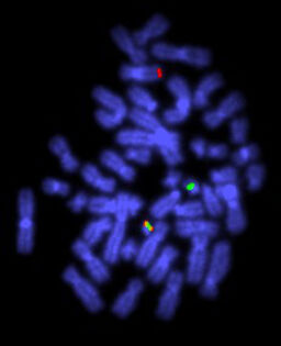 Translocation shown up by cosmid probes