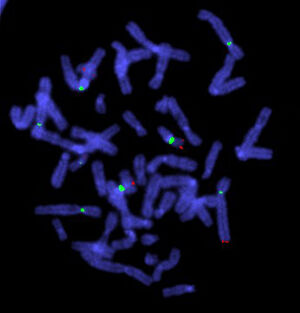 view Translocation shown up by cosmid probe