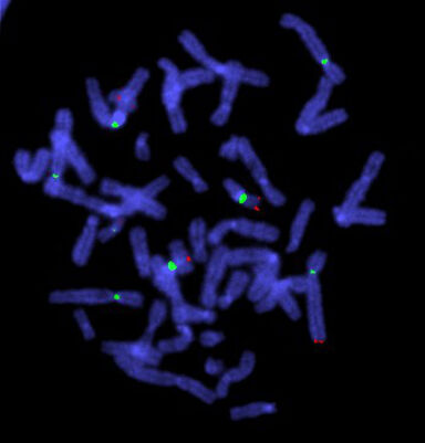 Translocation shown up by cosmid probe