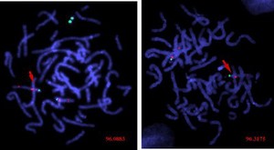 view Prader Willi & Angelman syndromes - FISH