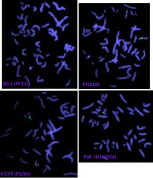 view Aniridia, Wilm's tumour, deletion - FISH