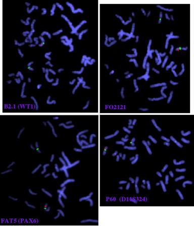 Aniridia, Wilm's tumour, deletion - FISH
