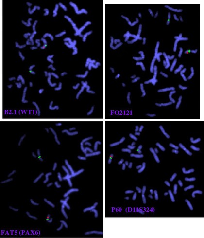 Aniridia, Wilm's tumour, deletion - FISH