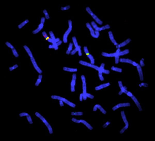 Duchenne muscular dystrophy deletion, FISH