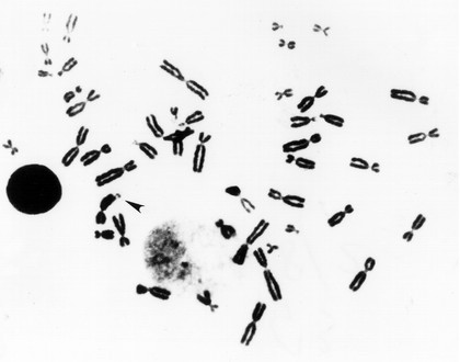 Fragile X metaphase spread + nucleus