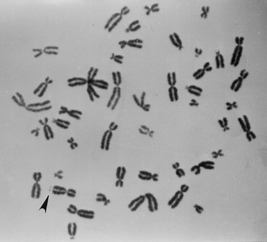 Fragile X metaphase spread