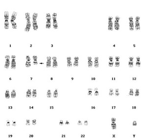 view Leukaemia karyotype, acute myelodysplasia