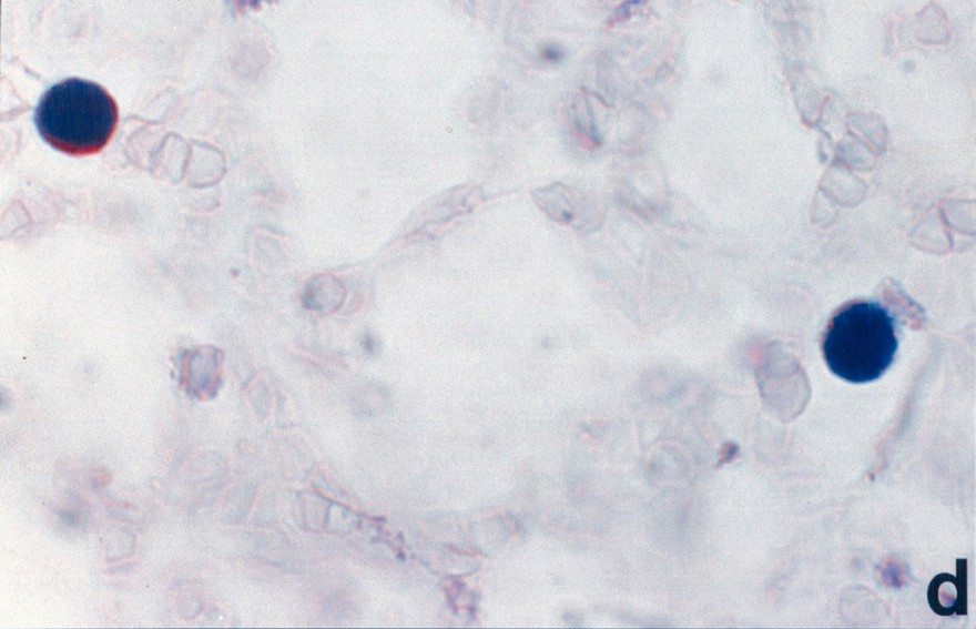 Fragile X diagnostic test - female carrier