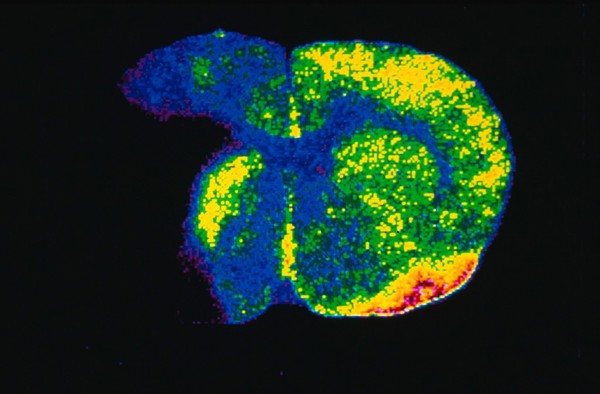 Ischaemia, blood flow through brain