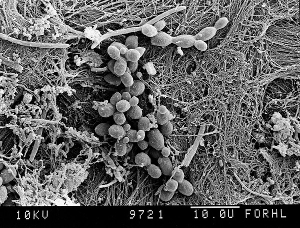 Yeasts in tooth with plaque.
