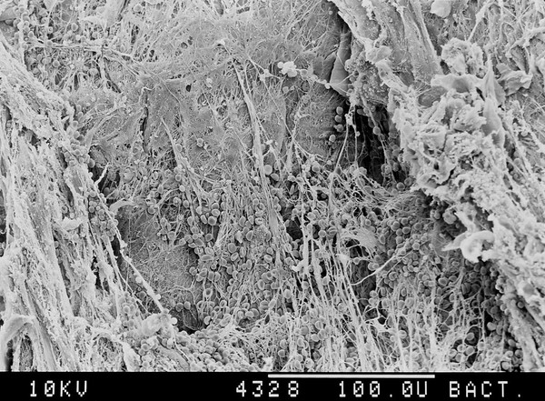 Electron micrograph of blood clot