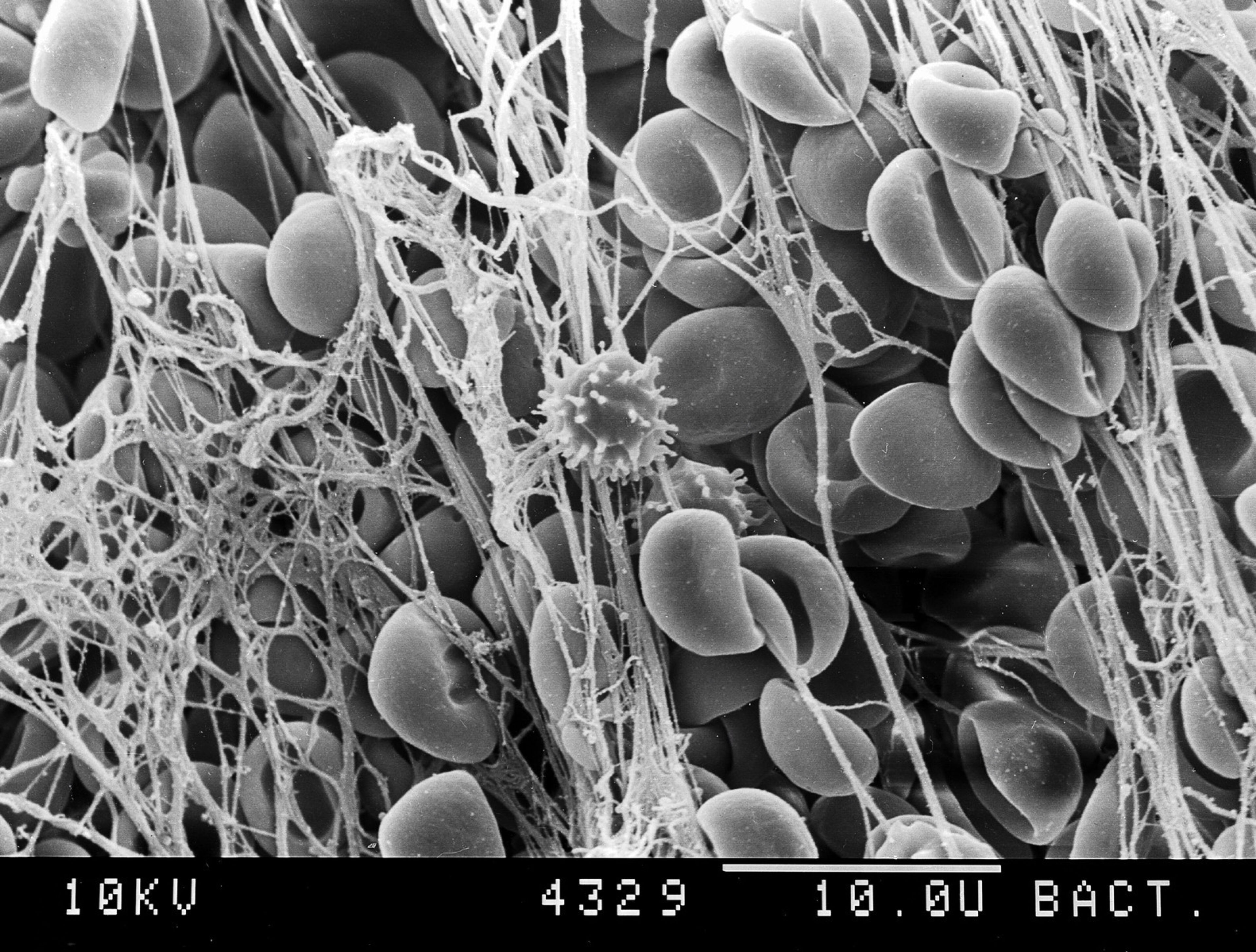 Electron micrograph of blood clot,high power