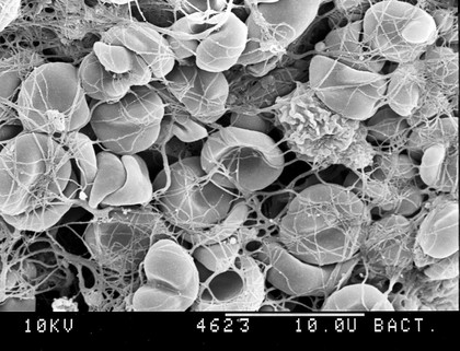 SEM of blood clot + one white corpuscle