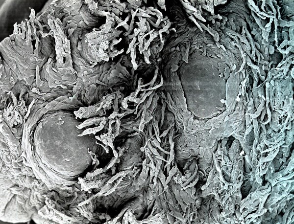 Psoriatic tongue, inc. fungiform papilla. SEM