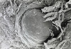 view Psoriatic tongue, fungiform papilla. SEM