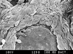 view Psoriatic tongue, SEM.